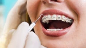 Transform your Smile with Adult Braces at Ipswich Family Dental, QLD