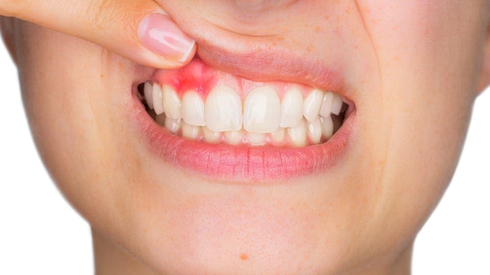 Periodontal Disease Treatment in QLD