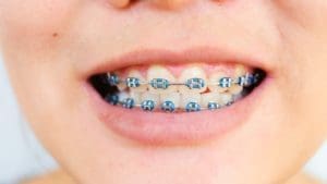 Custom Braces for Teeth Straightening in QLD