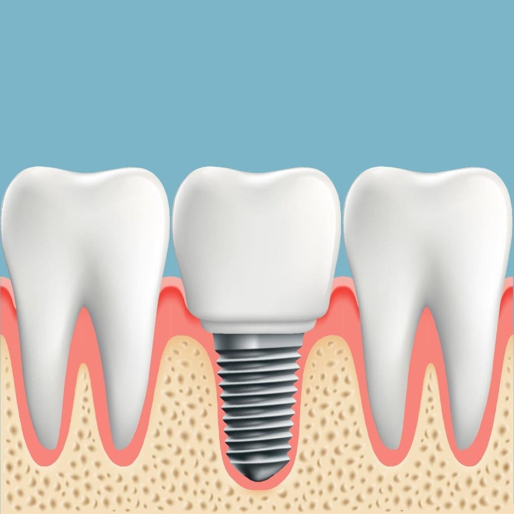 Dental Implants Services in QLD