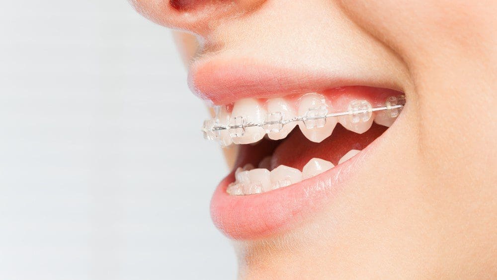 Professional Teeth Straightening Experts in QLD