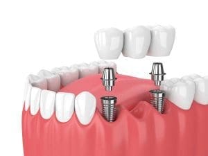 3d render of jaw and implants with dental bridge over white background