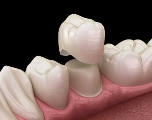 Dental crown premolar tooth assembly process. Medically accurate 3D illustration of human teeth treatment