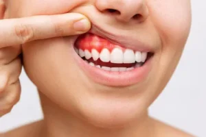 Gum Disease Cure at Ipswich Family Dental in QLD