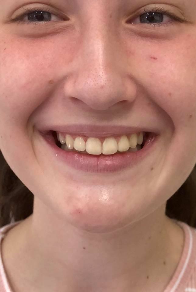 crooked teeth after straightening photo