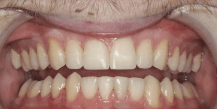 teeth straightening after photo