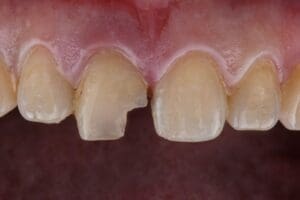 Chipped Teeth Treatment by Ipswich Family Dental Clinic