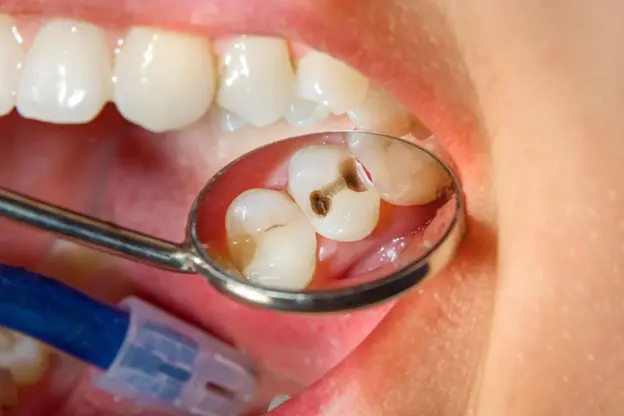 Tooth Cavity Filing Treatment by Ipswich Family Dental Clinic