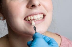 Reliable Dental Bonding Treatment in QLD